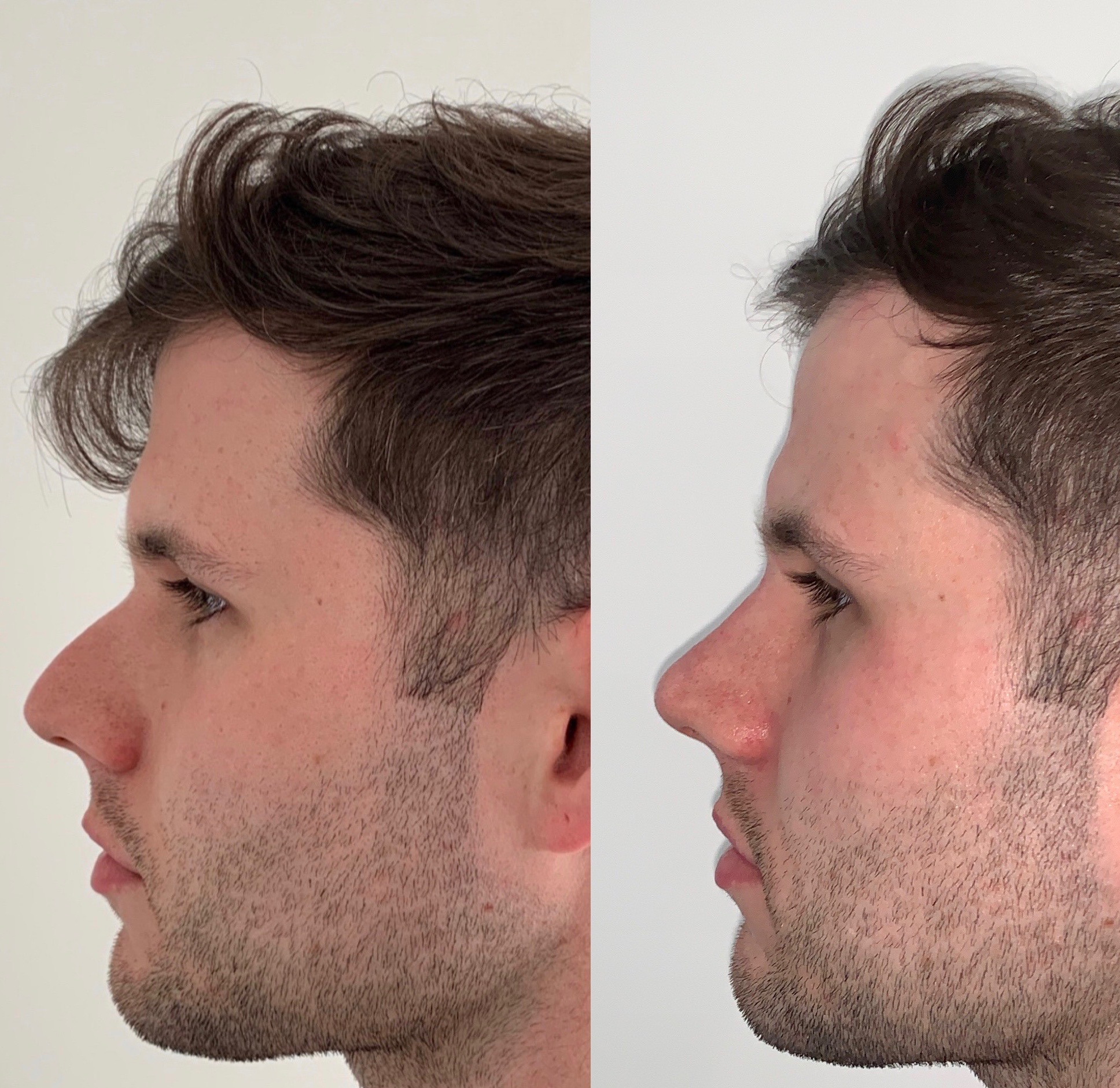 nose augmentation check skin
